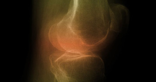 New Medical Method: Using Cartilage from the Nose to Pump and Repair Knee Cartilage