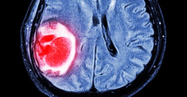 New Technique: Give Cancer Cells Luminescent Inside to Help Surgeons Remove