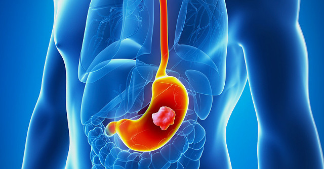 Often Heartburn Can Be a Sign of Stomach Cancer