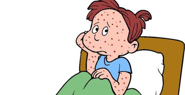 Parents Need to Know These Things to Protect Them When Chickenpox