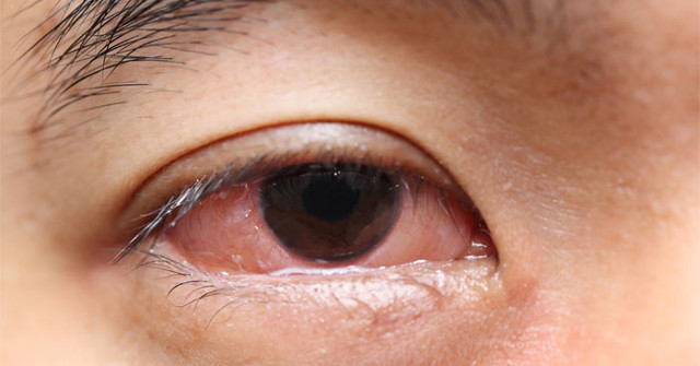 Partial Vision Can Be Restored Through New Gene Therapy