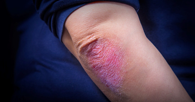 Psoriasis Overcome with Natural Ingredients
