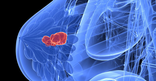 Researchers Have Figured Out How Breast Cancer Spreads to the Brain