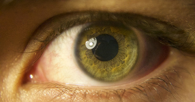 Scientifically Proven: Alzheimer's Dementia Signs Are Expressed Through the Retina of the Eye