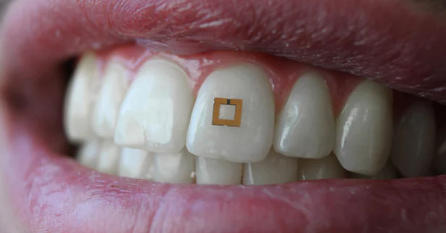 Sensors Mounted on Teeth Track What You Eat