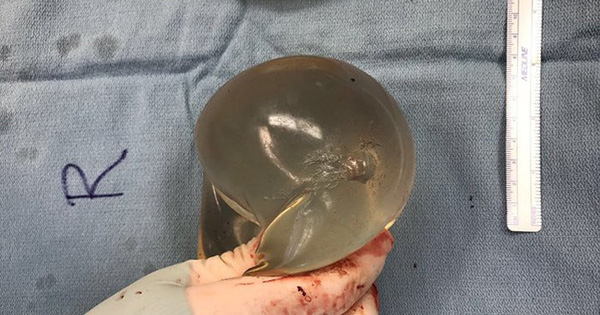 Silicone Breast Pads Deflect Bullets, Saving Canadian Girls'