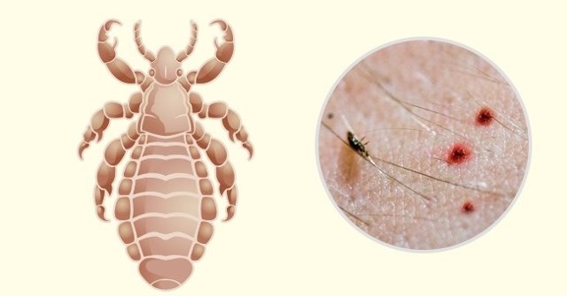 Simple Way to Identify Insect Bites