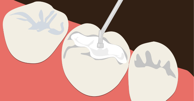Smoking, Drinking Alcohol Can Cause Complete Fillings: Dental