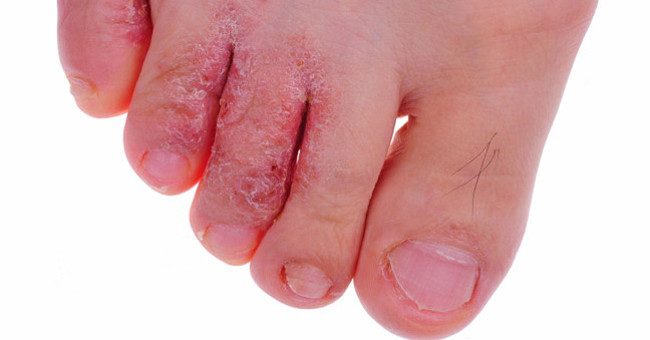 Solution for Treating Athlete's Foot: Foot Fungal Disease