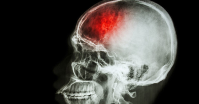 Stem Cells Help Patch Brain Damage in Stroke Victims