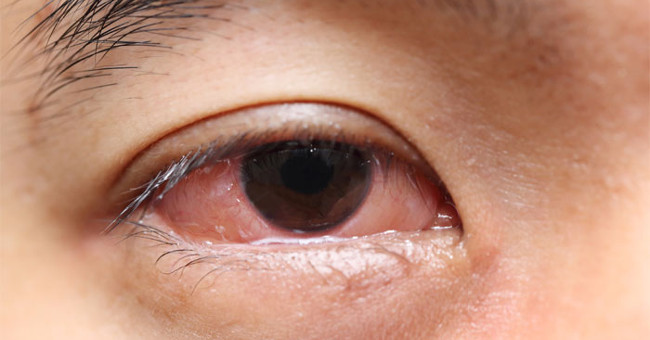 The 70 Mm Worm Was Found in the Eyes of a Woman in Kerala