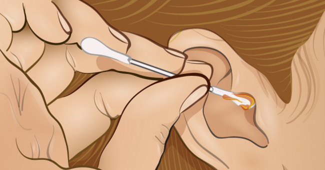 The Color of Earwax Helps You Identify Your Health Status
