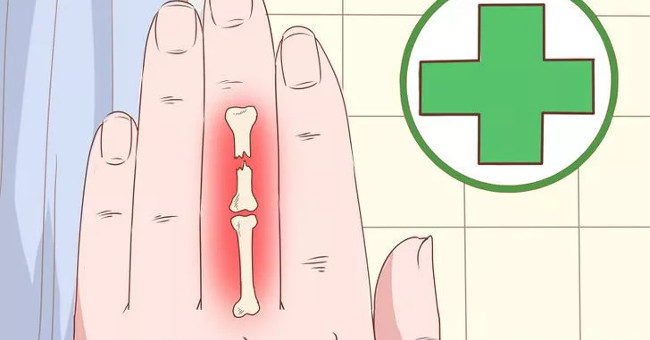 The First Aid Steps in Time When the Hand Jammed into the Door Gap