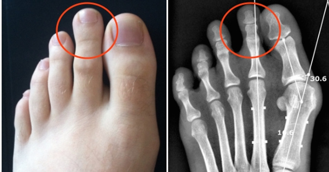 The Unexpected Truth About the Forefinger Was Longer Than the Big