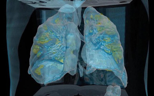 The Video Shows What Corona Virus Can Do to Patients' Lungs