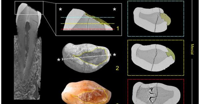The World's First Dental Fillings Are Found in Italy