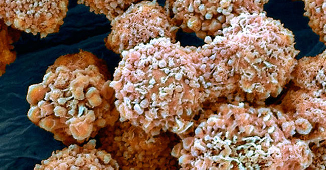 Therapy Using Hormones to Treat Prostate Cancer Is Dangerous for People with a History of Heart