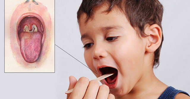 Things to Know About Diphtheria