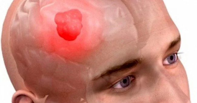 Things You Need to Know About Brain Cancer