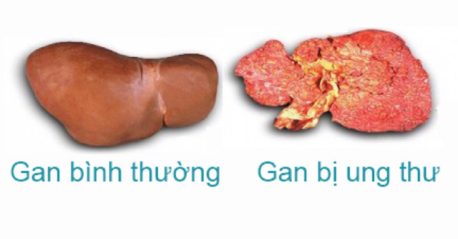 Want to Prevent Liver Cancer, Just Do 3 Things Well