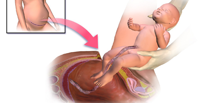 Warning: 'caesarean Section Increases the Risk of Childhood Obesity'