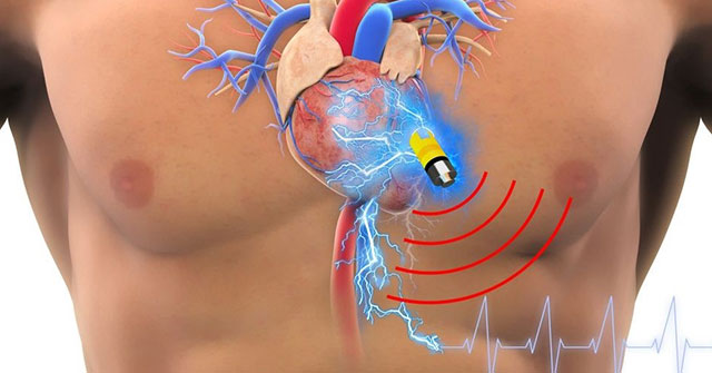 Welcome to 2017: Patients Using Pacemakers Should See a Doctor Soon to Be 'Patched'