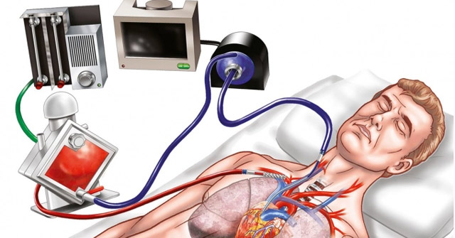What Is ECMO? in Which Case Does the Patient Need ECMO