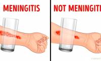 8 signs of childhood meningitis that parents should pay attention to