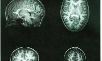 Children who survive a brain tumor have a very high body fat content