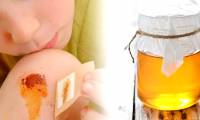 How to heal wounds quickly and effectively with honey