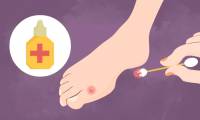 How to treat blisters when walking a lot, wearing tight shoes