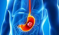 Often heartburn can be a sign of stomach cancer