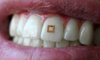 Sensors mounted on teeth track what you eat