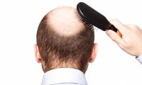The culprit causes hair loss when we get older