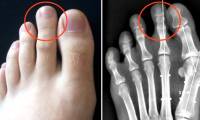 The unexpected truth about the forefinger was longer than the big toe