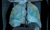 The video shows what corona virus can do to patients' lungs: Everyone, please take the flu very seriously.