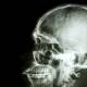 Photo of Finding a new substance capable of skull regeneration