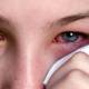 Photo of How to prevent and treat pinkeye