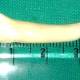 Indian dentist pulled out a record-breaking tooth