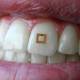 Photo of Sensors mounted on teeth track what you eat