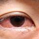 Photo of The 70 mm worm was found in the eyes of a woman in Kerala