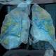 Photo of The video shows what corona virus can do to patients' lungs: Everyone, please take the flu very seriously.