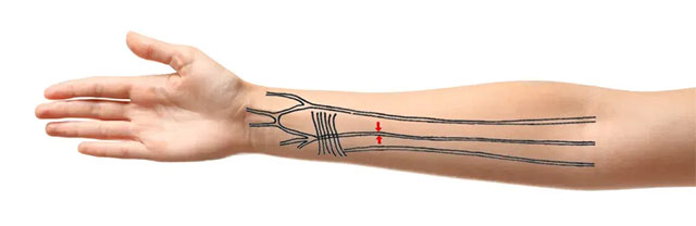 Picture 1 of Evolutionary angle: Humans are developing 'extra' arteries in the forearm