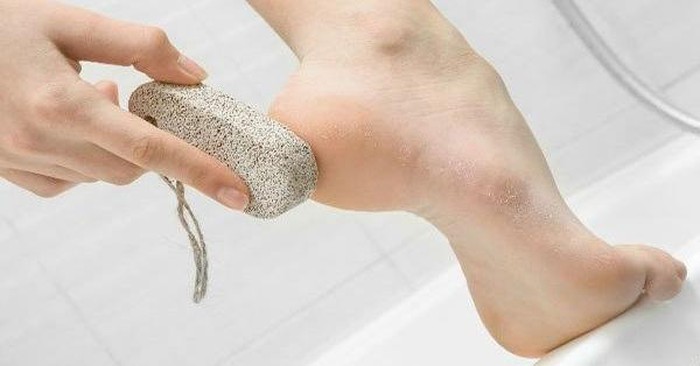 How to remove calluses on limbs Picture 3