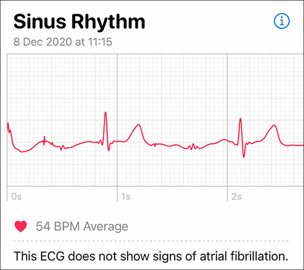 What health conditions can the Apple Watch recognize? Picture 3