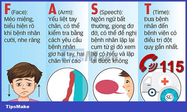 How to detect and treat a stroke early Picture 2