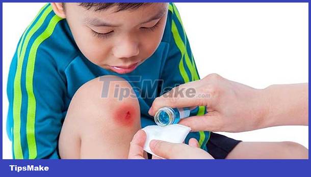 How to give first aid to some common accidents in children Picture 4