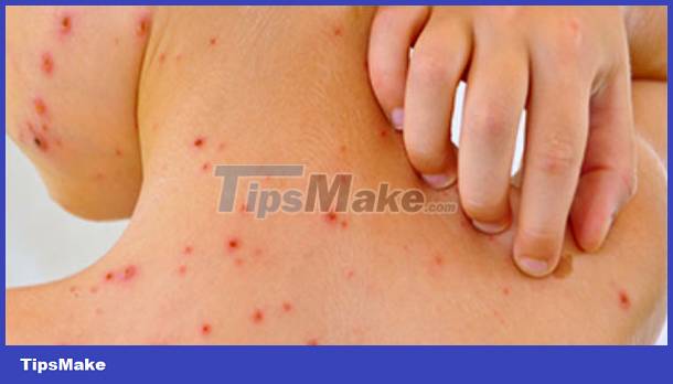 How to prevent and treat dengue fever Picture 1
