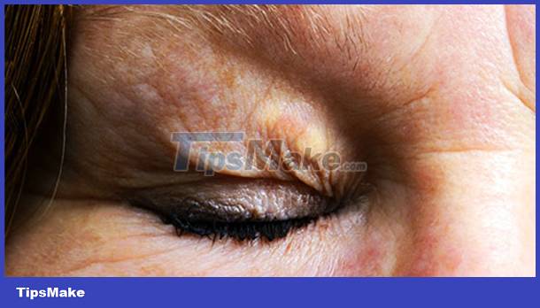 Signs on your face help identify your health Picture 11