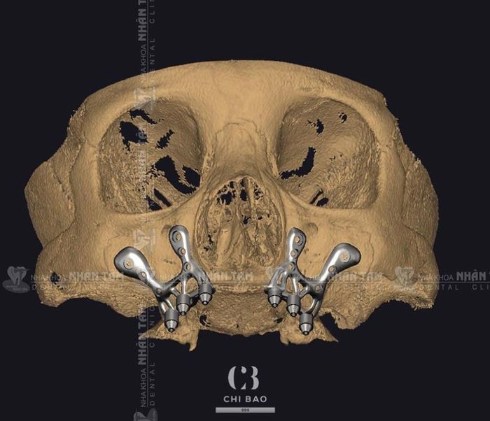 Personalized Implants: The Future of the Perfect Smile Picture 1